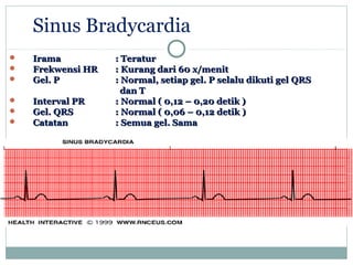 Sinus Bradycardia
 IramaIrama :: TeraturTeratur
 Frekwensi HRFrekwensi HR :: Kurang dari 60 x/menitKurang dari 60 x/menit
 Gel. PGel. P :: Normal, setiap gel. P selalu dikuti gelNormal, setiap gel. P selalu dikuti gel QRSQRS
dan Tdan T
 Interval PRInterval PR :: Normal ( 0,12 – 0,20 detik )Normal ( 0,12 – 0,20 detik )
 Gel. QRSGel. QRS :: Normal ( 0,06 – 0,12 detik )Normal ( 0,06 – 0,12 detik )
 CatatanCatatan :: Semua gel. SamaSemua gel. Sama
 
