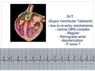 SVT
(Supra Ventrikular Takikardi)
- due to re-entry mechanisme
- narrow QRS complex
- Reguler
- Retrograde atrial
depolarization
- P wave ?
 