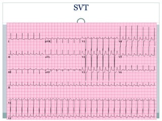 SVT
 