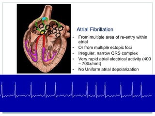 Atrial Fibrillation
- From multiple area of re-entry within
atrial
- Or from multiple ectopic foci
- Irreguler, narrow QRS complex
- Very rapid atrial electrical activity (400
– 700x/mnt)
- No Uniform atrial depolarization
 