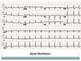 Atrial fibrillation
 