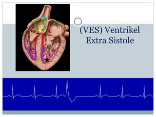 (VES) Ventrikel
Extra Sistole
 