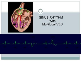 SR SR SR SR SR SR
VES VES
SINUS RHYTHM
With
Multifocal VES
 