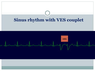 Sinus rhythm with VES couplet
ves
 