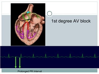Prolonged PR Interval
1st degree AV block
 
