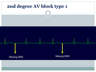 2nd degree AV block type 1
Missing QRS Missing QRS
 