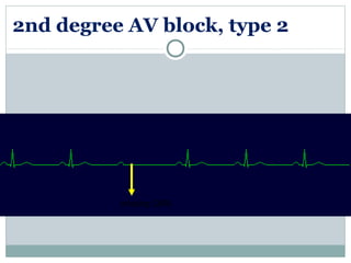 2nd degree AV block, type 2
missing QRS
 