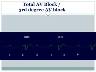Total AV Block /
3rd degree AV block
QRS
P P P P P P
QRS
 
