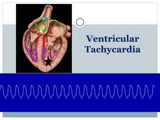 Ventricular
Tachycardia
 