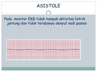 ASISTOLE
Pada monitor EKG tidak tampak aktivitas listrik
jantung dan tidak terabanya denyut nadi pasien
 