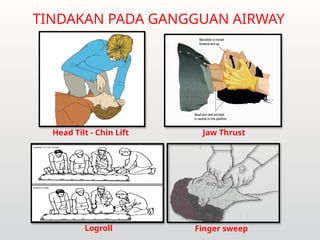 TINDAKAN PADA GANGGUAN AIRWAY
Head Tilt - Chin Lift Jaw Thrust
Logroll Finger sweep
 