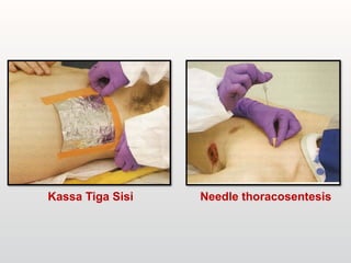 Needle thoracosentesis
Kassa Tiga Sisi
 
