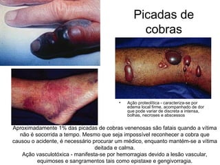 Picadas de
cobras
• Ação proteolítica - caracteriza-se por
edema local firme, acompanhado de dor
que pode variar de discreta a intensa,
bolhas, necroses e abscessos
Aproximadamente 1% das picadas de cobras venenosas são fatais quando a vítima
não é socorrida a tempo. Mesmo que seja impossível reconhecer a cobra que
causou o acidente, é necessário procurar um médico, enquanto mantém-se a vítima
deitada e calma.
Ação vasculotóxica - manifesta-se por hemorragias devido a lesão vascular,
equimoses e sangramentos tais como epistaxe e gengivorragia.
 