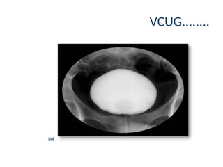 405980657-Uretrocystografi-ppt.ppt uretrocyctografi | PPT