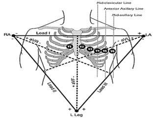 407118812-A-12-lead-electrocardiogram-ECG-ppt.ppt