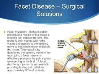 Facet disease | PPTX