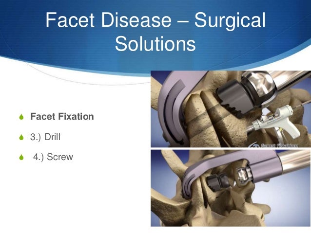 Facet disease