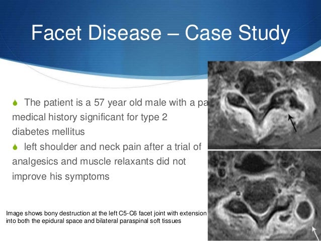 Facet disease