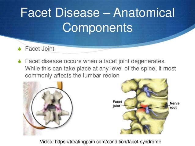 Facet disease