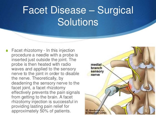 Facet disease