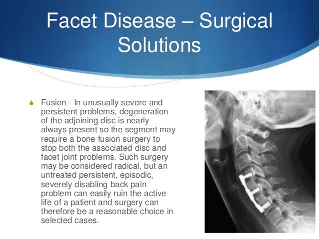 Facet disease