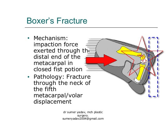 fractures of hand bones