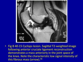 40 intra articular masses on magnetic resonance imaging | PPTX
