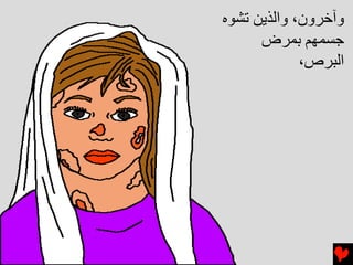 ‫وﺁﺥﺮون، واﻟﺬﻳﻦ ﺕﺸﻮﻩ‬
      ‫ﺝﺴﻤﻬﻢ ﺏﻤﺮض‬
             ‫اﻟﺒﺮص،‬
 