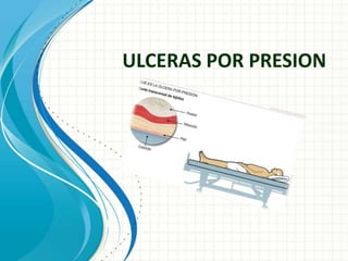 ULCERAS POR PRESION

 