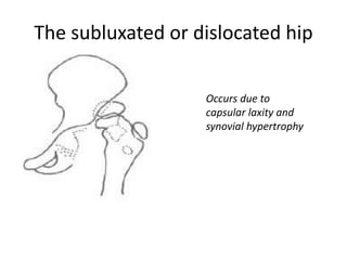 The subluxated or dislocated hip
Occurs due to
capsular laxity and
synovial hypertrophy
 
