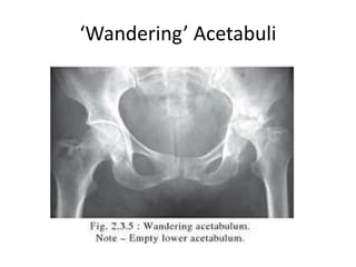 ‘Wandering’ Acetabuli
 