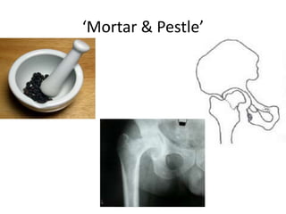 ‘Mortar & Pestle’
 
