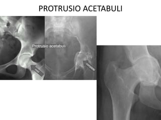 PROTRUSIO ACETABULI
 