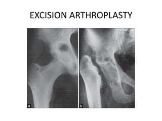 EXCISION ARTHROPLASTY
 