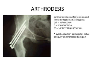 ARTHRODESIS
optimal positioning for function and
limited effect on adjacent joints
200 – 350 FLEXION
0 – 50 ADDUCTION
50 – 100 EXTERNAL ROTATION
* avoid abduction as it creates pelvic
obliquity and increased back pain
 
