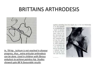 BRITTAINS ARTHRODESIS
In, TB hip , ischium is not reached in disease
progress, thus , extra articular arthrodesis
can be done. Used in children with fibrous
ankylosis to achieve painless hip. Studies
showed upto 88 % favourable results.
 
