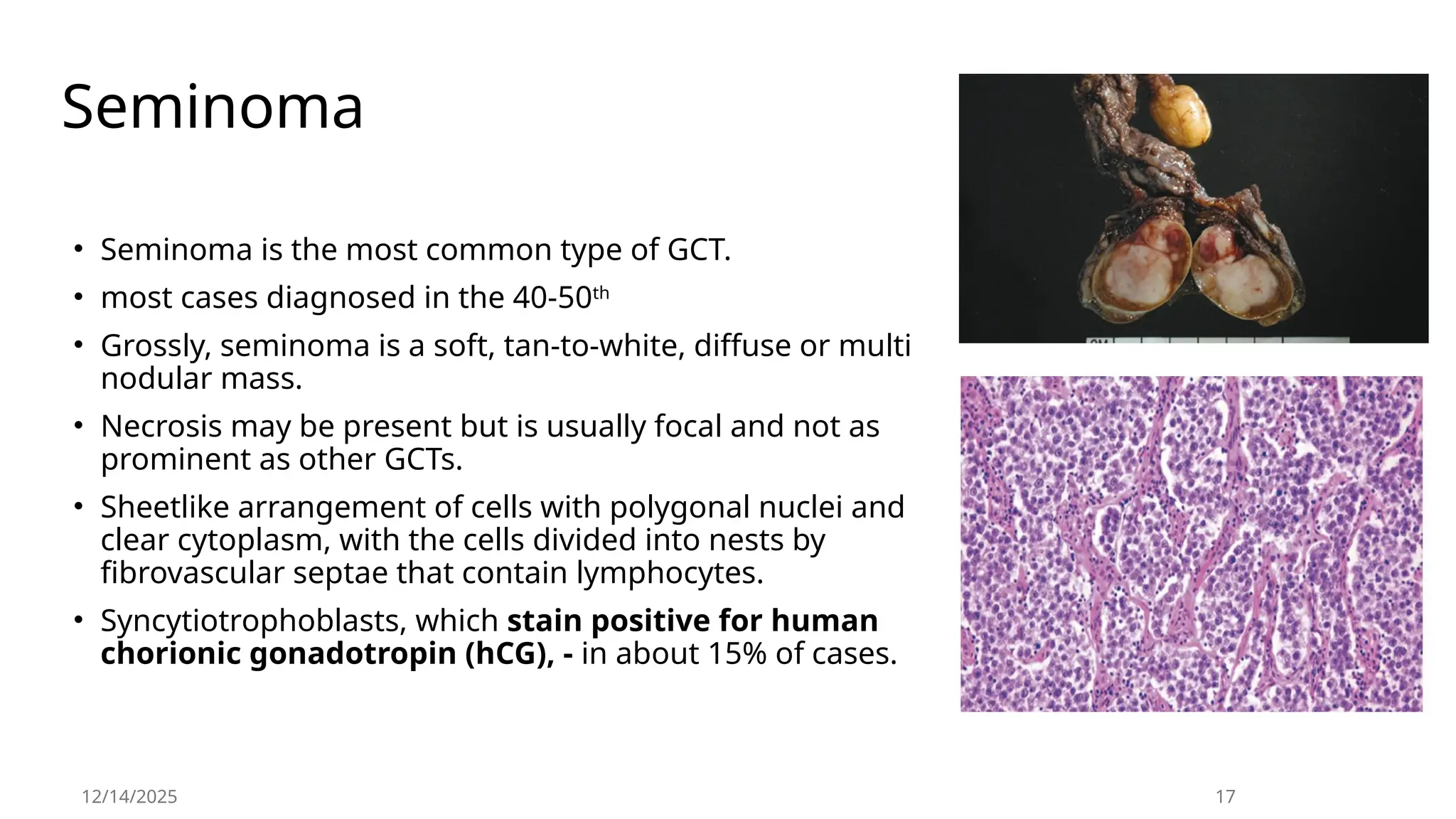Seminoma
• Seminoma is the most common type of GCT.
• most cases diagnosed in the 40-50th
• Grossly, seminoma is a soft, tan-to-white, diffuse or multi
nodular mass.
• Necrosis may be present but is usually focal and not as
prominent as other GCTs.
• Sheetlike arrangement of cells with polygonal nuclei and
clear cytoplasm, with the cells divided into nests by
fibrovascular septae that contain lymphocytes.
• Syncytiotrophoblasts, which stain positive for human
chorionic gonadotropin (hCG), - in about 15% of cases.
12/14/2025 17
 