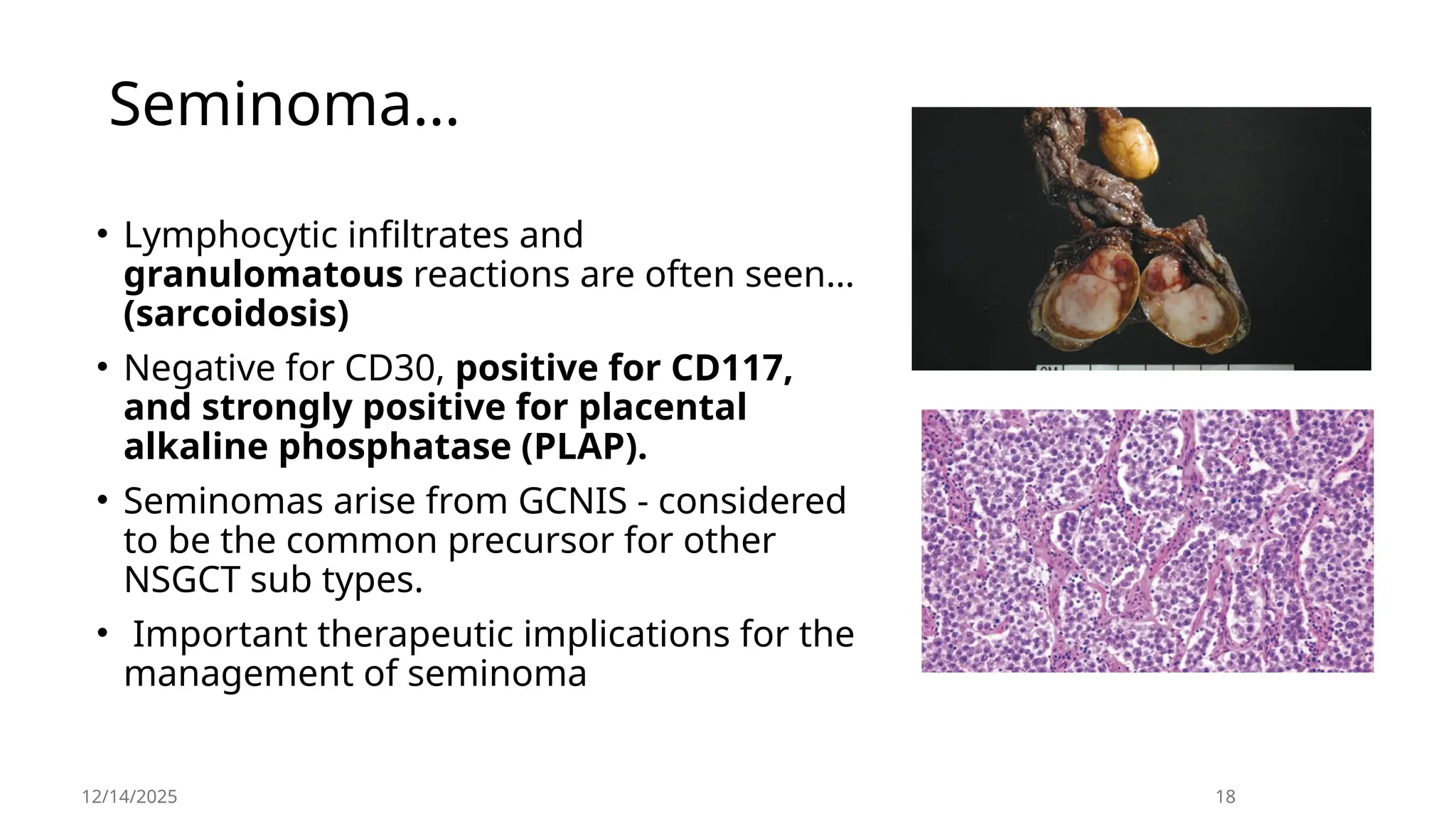Seminoma…
• Lymphocytic infiltrates and
granulomatous reactions are often seen…
(sarcoidosis)
• Negative for CD30, positive for CD117,
and strongly positive for placental
alkaline phosphatase (PLAP).
• Seminomas arise from GCNIS - considered
to be the common precursor for other
NSGCT sub types.
• Important therapeutic implications for the
management of seminoma
12/14/2025 18
 
