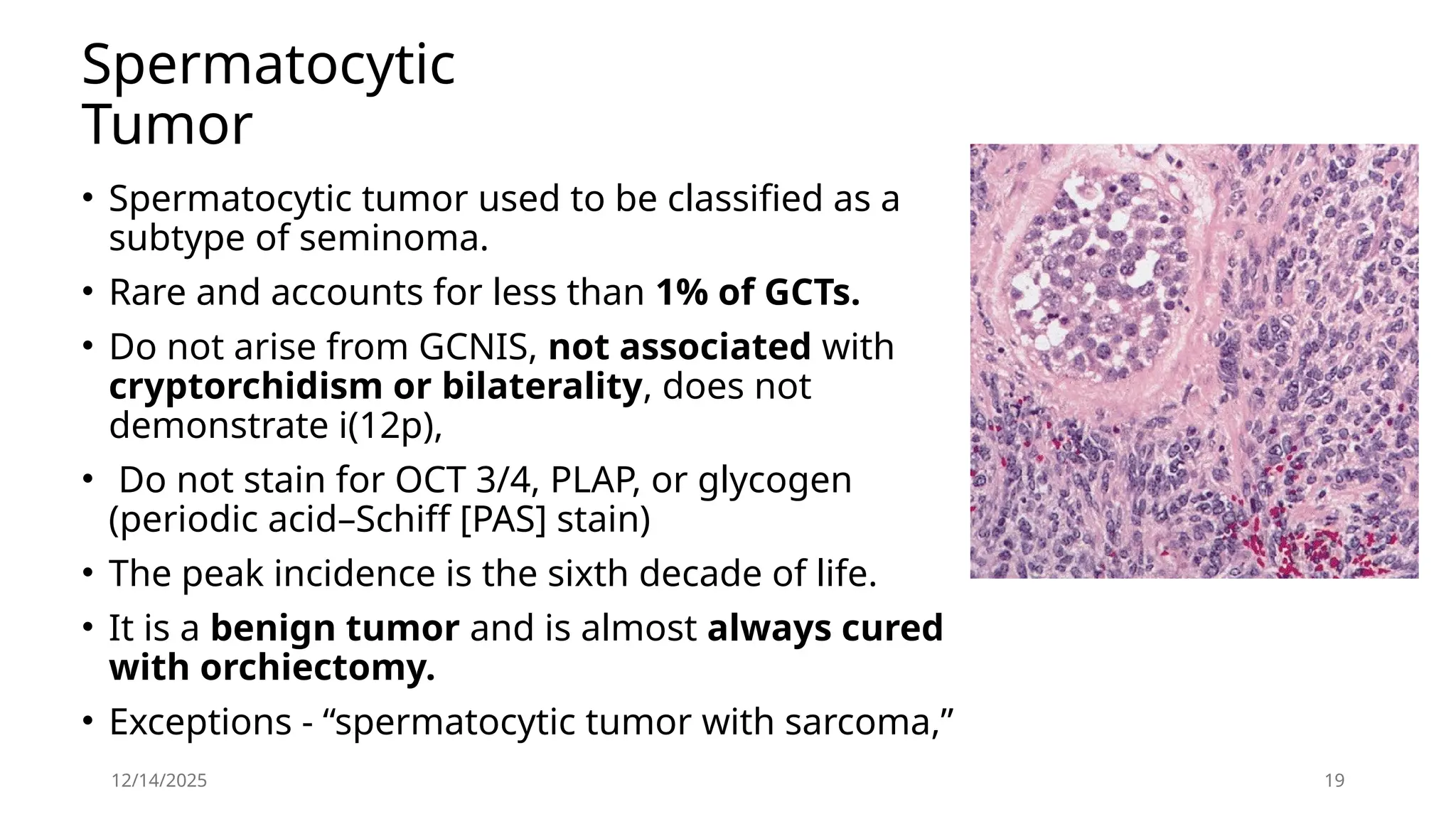 12/14/2025 19
Spermatocytic
Tumor
• Spermatocytic tumor used to be classified as a
subtype of seminoma.
• Rare and accounts for less than 1% of GCTs.
• Do not arise from GCNIS, not associated with
cryptorchidism or bilaterality, does not
demonstrate i(12p),
• Do not stain for OCT 3/4, PLAP, or glycogen
(periodic acid–Schiff [PAS] stain)
• The peak incidence is the sixth decade of life.
• It is a benign tumor and is almost always cured
with orchiectomy.
• Exceptions - “spermatocytic tumor with sarcoma,”
 