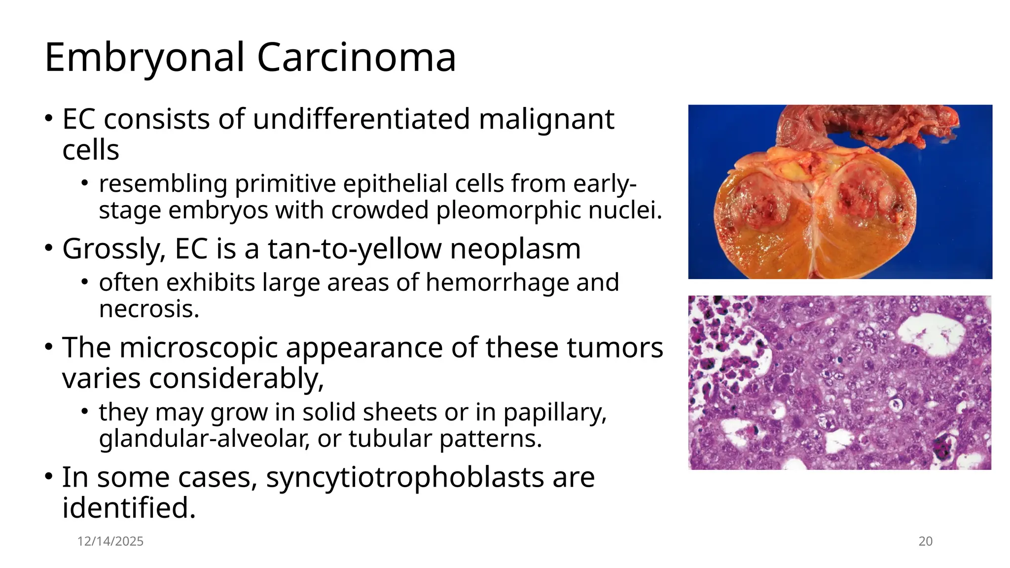 12/14/2025 20
Embryonal Carcinoma
• EC consists of undifferentiated malignant
cells
• resembling primitive epithelial cells from early-
stage embryos with crowded pleomorphic nuclei.
• Grossly, EC is a tan-to-yellow neoplasm
• often exhibits large areas of hemorrhage and
necrosis.
• The microscopic appearance of these tumors
varies considerably,
• they may grow in solid sheets or in papillary,
glandular-alveolar, or tubular patterns.
• In some cases, syncytiotrophoblasts are
identified.
 
