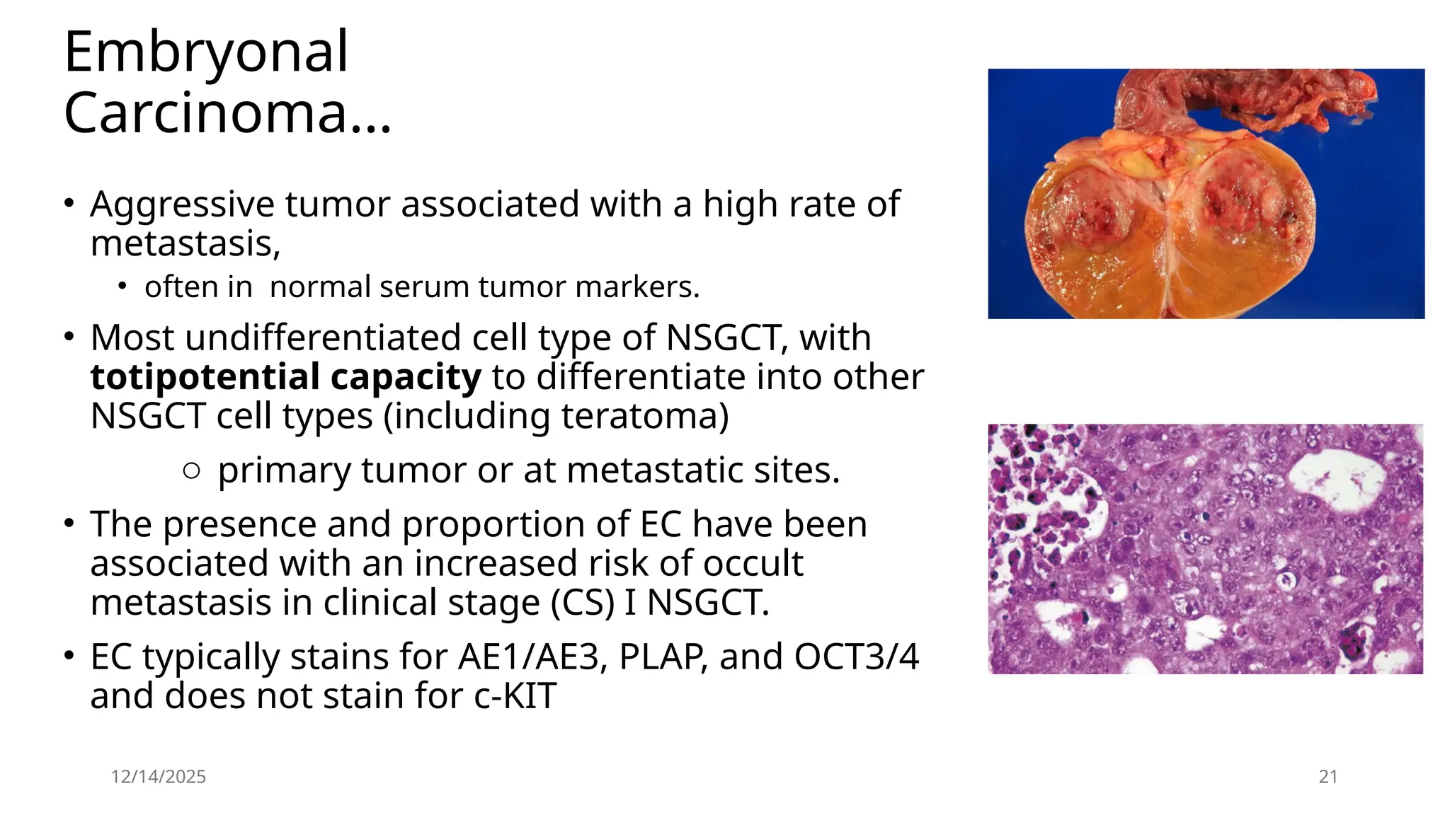 Embryonal
Carcinoma…
• Aggressive tumor associated with a high rate of
metastasis,
• often in normal serum tumor markers.
• Most undifferentiated cell type of NSGCT, with
totipotential capacity to differentiate into other
NSGCT cell types (including teratoma)
o primary tumor or at metastatic sites.
• The presence and proportion of EC have been
associated with an increased risk of occult
metastasis in clinical stage (CS) I NSGCT.
• EC typically stains for AE1/AE3, PLAP, and OCT3/4
and does not stain for c-KIT
12/14/2025 21
 