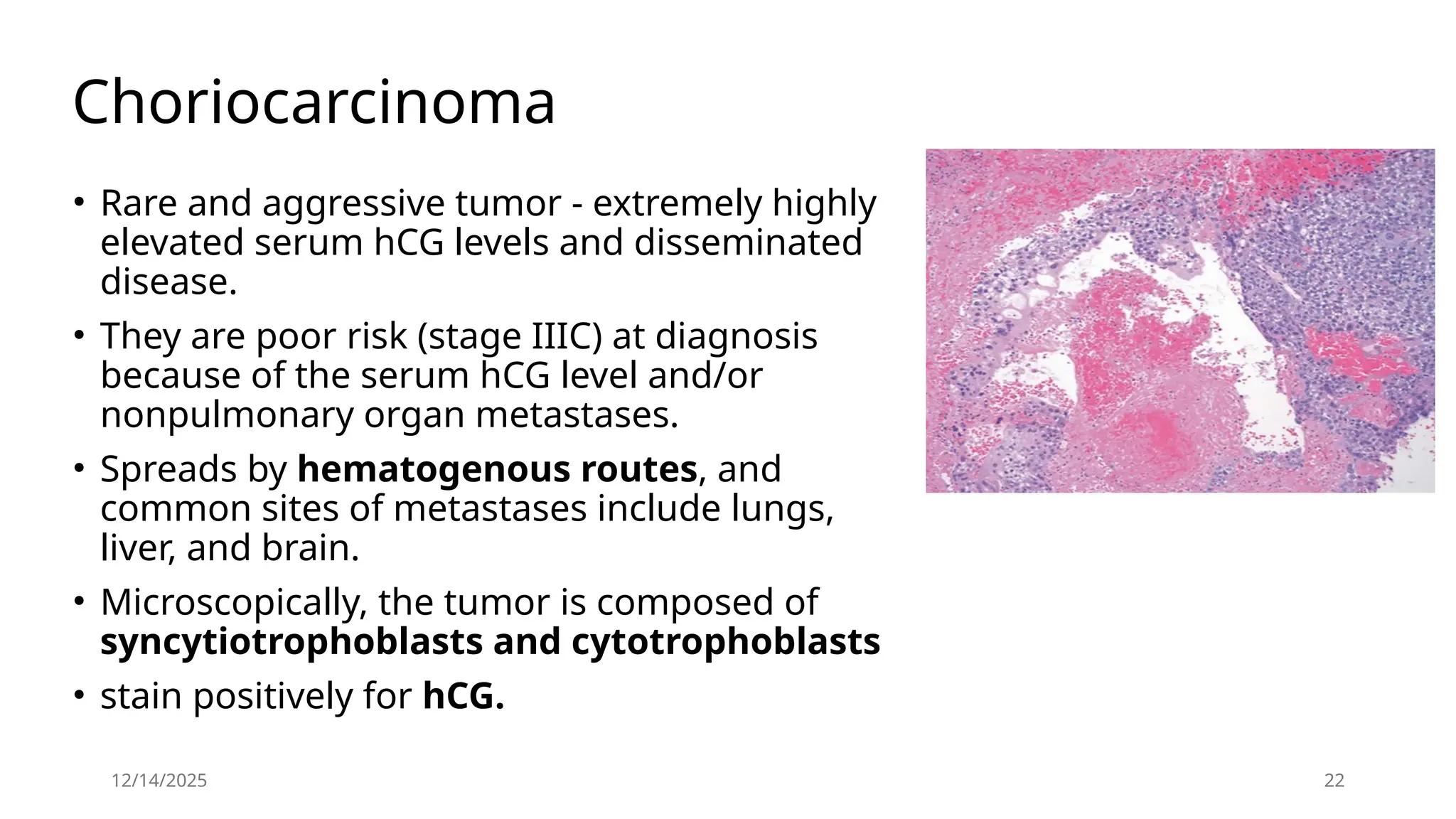 12/14/2025 22
Choriocarcinoma
• Rare and aggressive tumor - extremely highly
elevated serum hCG levels and disseminated
disease.
• They are poor risk (stage IIIC) at diagnosis
because of the serum hCG level and/or
nonpulmonary organ metastases.
• Spreads by hematogenous routes, and
common sites of metastases include lungs,
liver, and brain.
• Microscopically, the tumor is composed of
syncytiotrophoblasts and cytotrophoblasts
• stain positively for hCG.
 