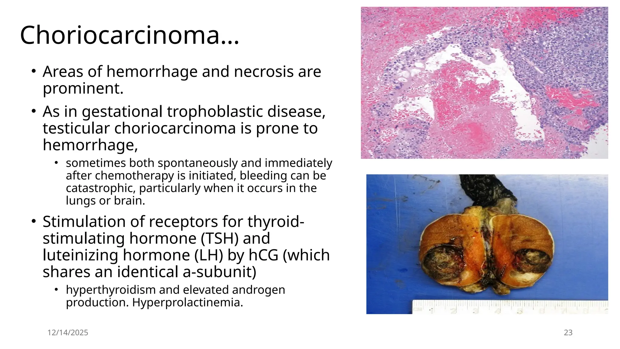 12/14/2025 23
Choriocarcinoma…
• Areas of hemorrhage and necrosis are
prominent.
• As in gestational trophoblastic disease,
testicular choriocarcinoma is prone to
hemorrhage,
• sometimes both spontaneously and immediately
after chemotherapy is initiated, bleeding can be
catastrophic, particularly when it occurs in the
lungs or brain.
• Stimulation of receptors for thyroid-
stimulating hormone (TSH) and
luteinizing hormone (LH) by hCG (which
shares an identical a-subunit)
• hyperthyroidism and elevated androgen
production. Hyperprolactinemia.
 