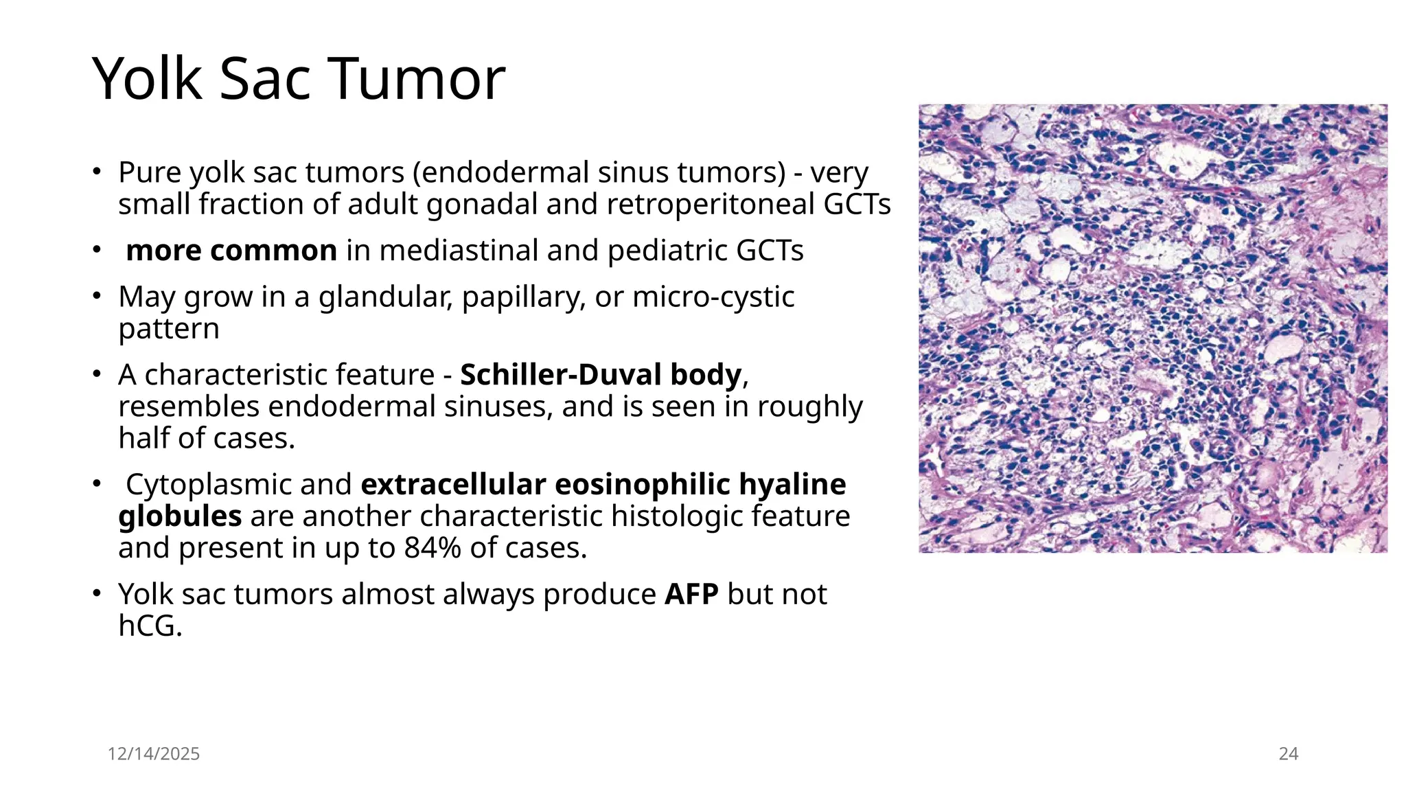 12/14/2025 24
Yolk Sac Tumor
• Pure yolk sac tumors (endodermal sinus tumors) - very
small fraction of adult gonadal and retroperitoneal GCTs
• more common in mediastinal and pediatric GCTs
• May grow in a glandular, papillary, or micro-cystic
pattern
• A characteristic feature - Schiller-Duval body,
resembles endodermal sinuses, and is seen in roughly
half of cases.
• Cytoplasmic and extracellular eosinophilic hyaline
globules are another characteristic histologic feature
and present in up to 84% of cases.
• Yolk sac tumors almost always produce AFP but not
hCG.
 
