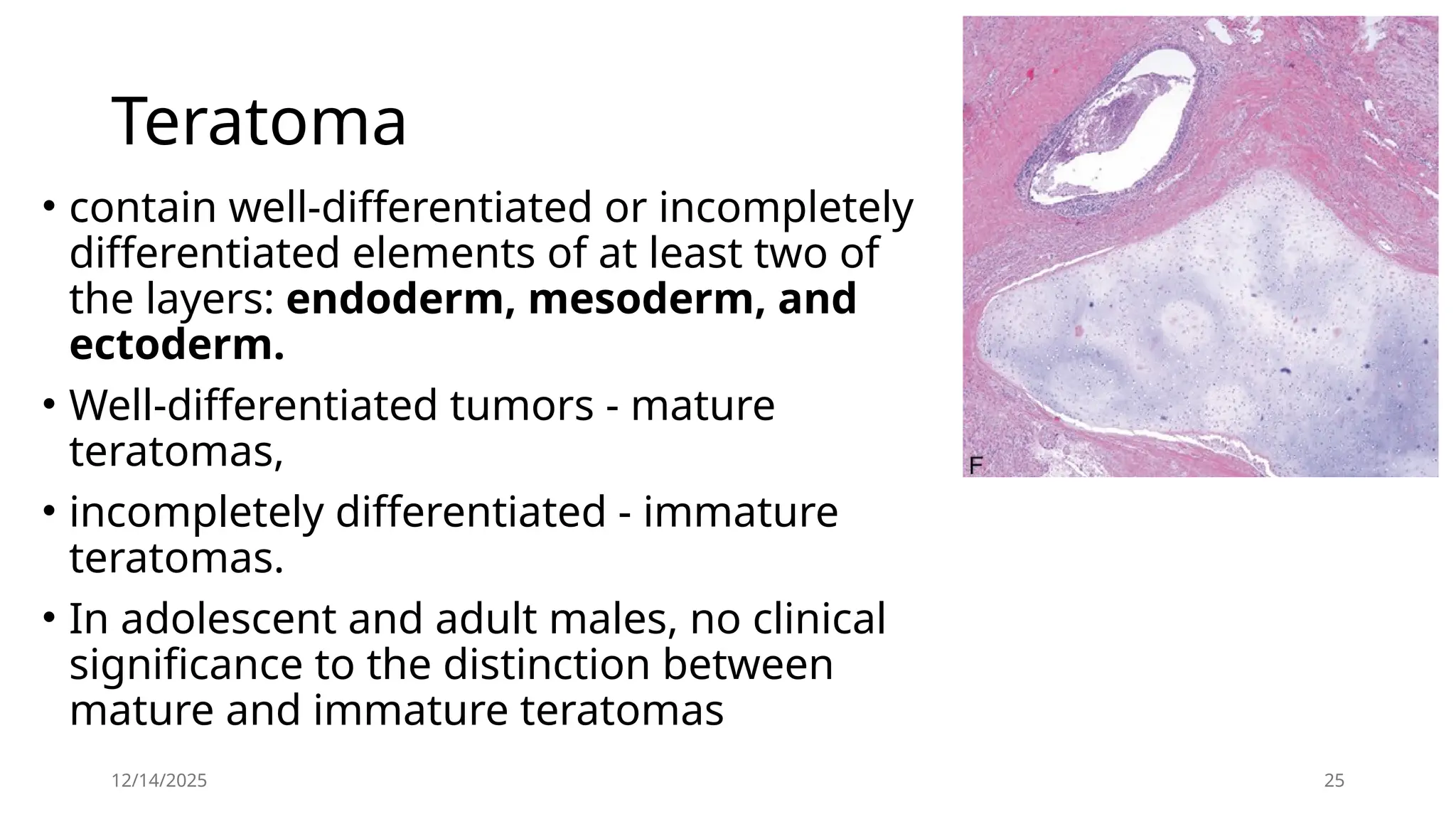 12/14/2025 25
Teratoma
• contain well-differentiated or incompletely
differentiated elements of at least two of
the layers: endoderm, mesoderm, and
ectoderm.
• Well-differentiated tumors - mature
teratomas,
• incompletely differentiated - immature
teratomas.
• In adolescent and adult males, no clinical
significance to the distinction between
mature and immature teratomas
 