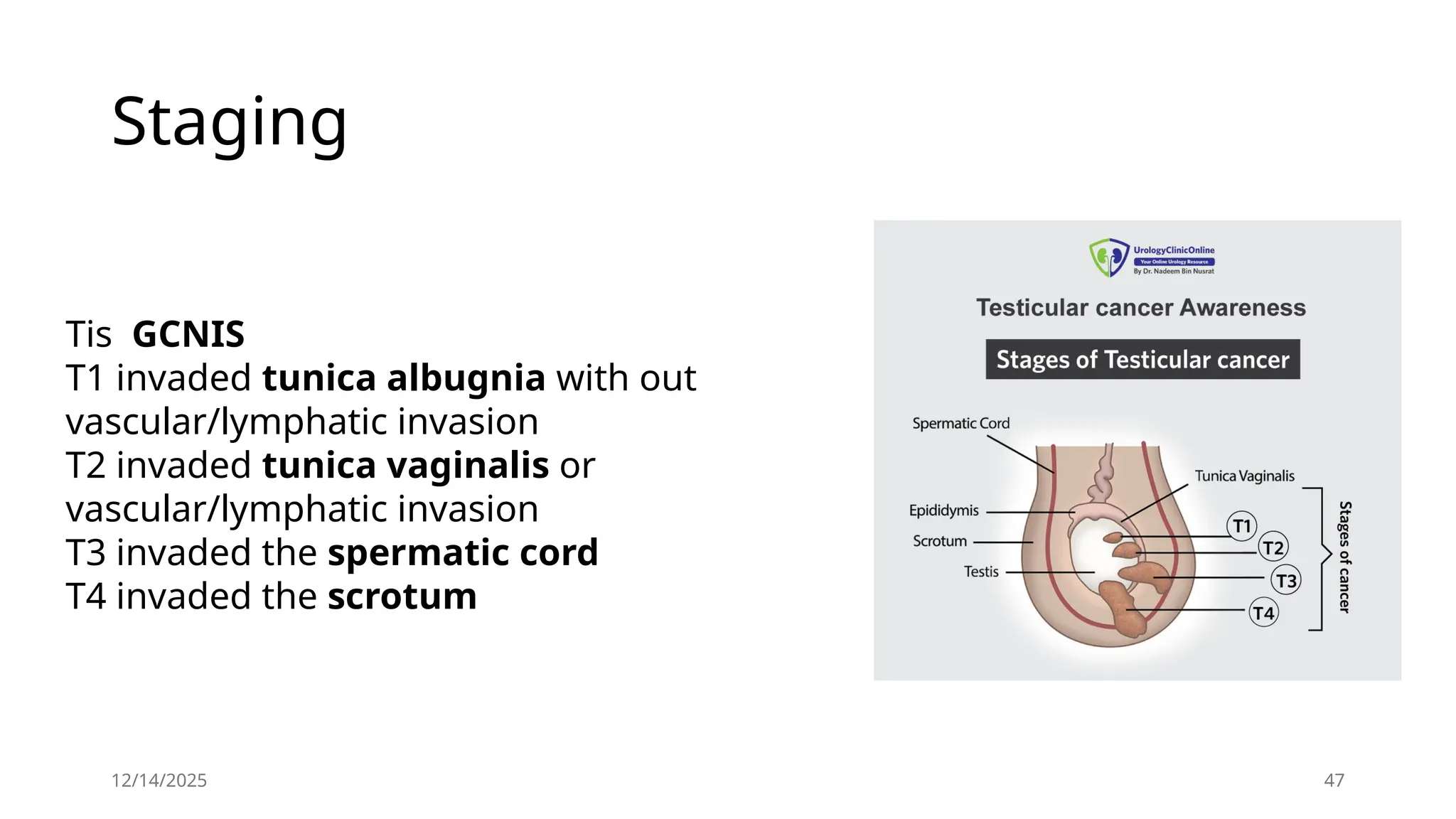 12/14/2025 47
Staging
Tis GCNIS
T1 invaded tunica albugnia with out
vascular/lymphatic invasion
T2 invaded tunica vaginalis or
vascular/lymphatic invasion
T3 invaded the spermatic cord
T4 invaded the scrotum
 