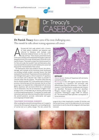 S K I N / D E R M AT O L O G Y
41Aesthetic Medicine • May 2015
SPONSORED BY CASE FILESwww.aestheticmed.co.uk
Dr Patrick Treacy shares some of his most challenging cases.
This month he talks about treating squamous cell cancer
Dr Treacy’s
CASEBOOK
A
64-year-old Irish male patient with a history
of male pattern baldness and leukemia was
referred to Ailesbury with multiple scaly
thickened reddened lesions on the area of his
scalp and face. These lesions presented mostly
onhisnose,templesandforeheadwiththelargestcollection
along the vertex of his scalp. He had lived in South Africa for
nearly 20 years. There were at least four lesions present on
his face and scalp that wouldn’t heal and bled easily when
traumatized. More recently his wife had become concerned
because her friend had died of skin cancer.
On examination there was evidence chronic skin photo-
damage, with multiple actinic keratoses (solar keratoses)
surrounding multiple eroded, ulcerated lesions that bled
easilywhentraumatized.Thepresenceofulceratedborders,
and telangiectases gave a clinical suspicion of squamous
cell carcinoma and a decision was made to proceed to
removal rather than do a biopsy. The author feels that any
doctor should consider SCC in any patient with a history of
previous chemotherapy and skin anomaly that do not heal
occurring on sun-exposed skin. Unlike basal cell carcinoma
(BCC), squamous cell carcinoma (SCC) has a substantial
risk of metastasis. The risk of metastasis is higher in SCC
arising in scars, on the lower lips or mucosa, and occurring
in immunosuppressed patients. To evaluate for lymph node
metastasis, particular attention should be taken to examine
the parotid posterior auricular, suboccipital, and upper
cervical groups of lymph nodes.1
TREATMENT (EXCISIONAL SURGERY)
Afternumbingtheareawithlocalanesthesia,an11scalpelto
remove the entire growth along with a surrounding border
of normal skin as a safety margin. The skin around the
HISTOLOGY
Clinical details: History of Squamous cell carcinoma.
Leukaemic patient.
Microscopy: A: Skin, left zygoma, excision: Specimen
corresponds to a squamous cell carcinoma, well
differentiated. Maximum dimension = 2mm. Depth of
invasion=1.1mmClarklevel4.Lymphovascularinvasion
not identified. Perineural invasion not identified.
Margins: Closest margin = 2mm. Deep margin =
uninvolved. Pathological stage (TNM 7’h edition):
pTl. The second described specimen corresponds to
actinic keratosis.
surgical site is then closed with a number of stitches, and
the excised tissue is sent to the laboratory for microscopic
examination to verify that all the malignant cells have been
removed.
 