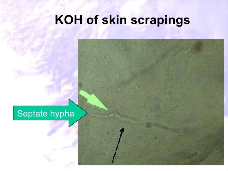 41. laboratory diagnosis of common fungal diseases