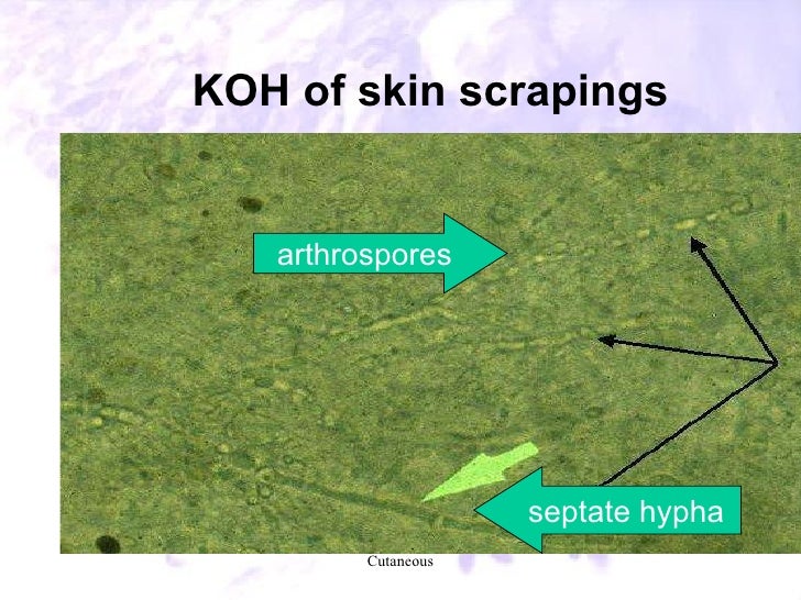 41. laboratory diagnosis of common fungal diseases