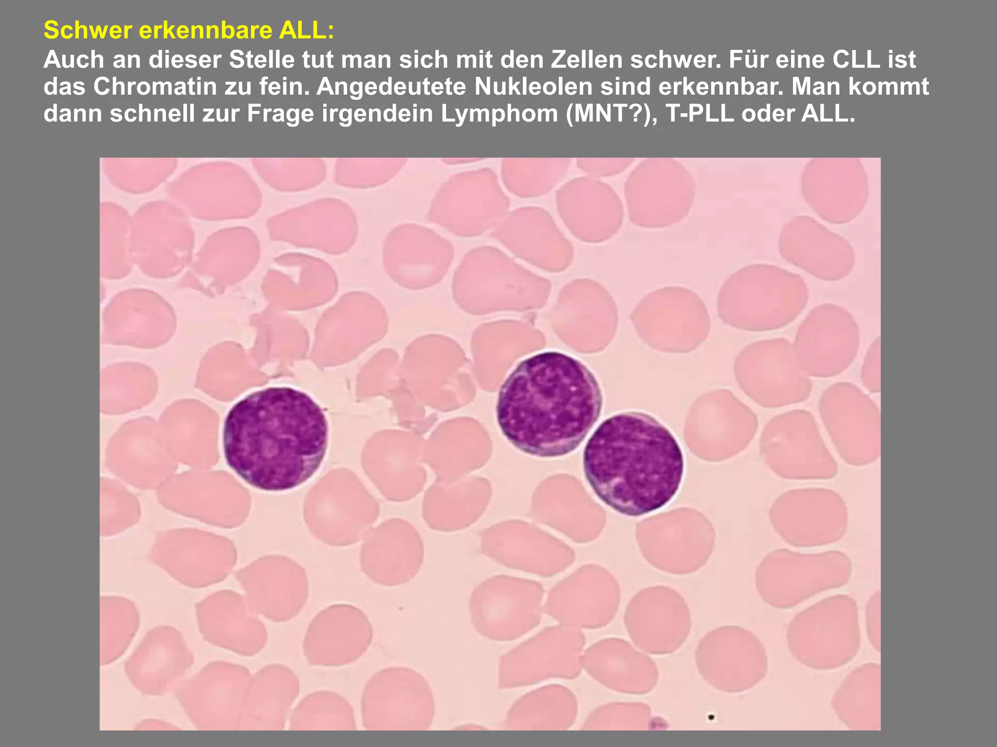 Akute Lymphatische Leukämie Besser Verstehen – KUETRV